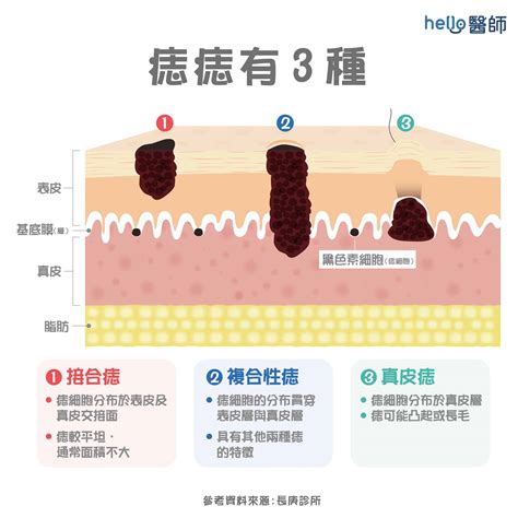 男生臉上很多痣|痣形成的原因？痣長毛、痣變多變大是痣病變？5招判別